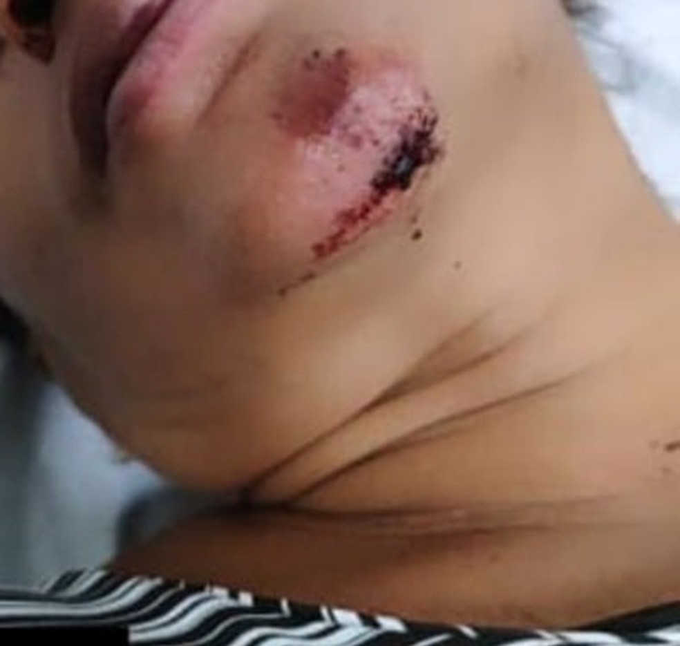 Mulher ficou ferida após ser agredida por dois homens que invadiram sua casa na madrugada desta terça-feira (7) no RN — Foto: Reprodução