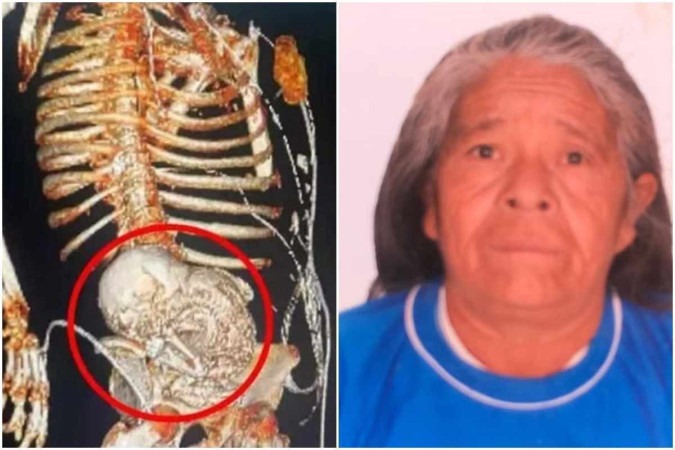 Daniela Almeida Vera, de 81 anos, ficou com feto calcificado no corpo por mais de 50 anos -  (crédito: Divulgação e Arquivo pessoal)