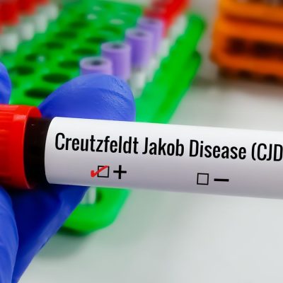 A doença de Creutzfeldt-Jakob (DCJ) é um distúrbio cerebral raro e que piora rapidamente, causando mudanças únicas no tecido cerebral e afetando a coordenação muscular, o pensamento e a memória. Foto: Saiful52/ AdobeStock